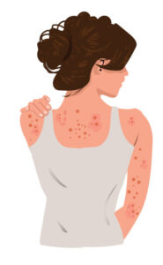 Hidradenitis Suppurativa